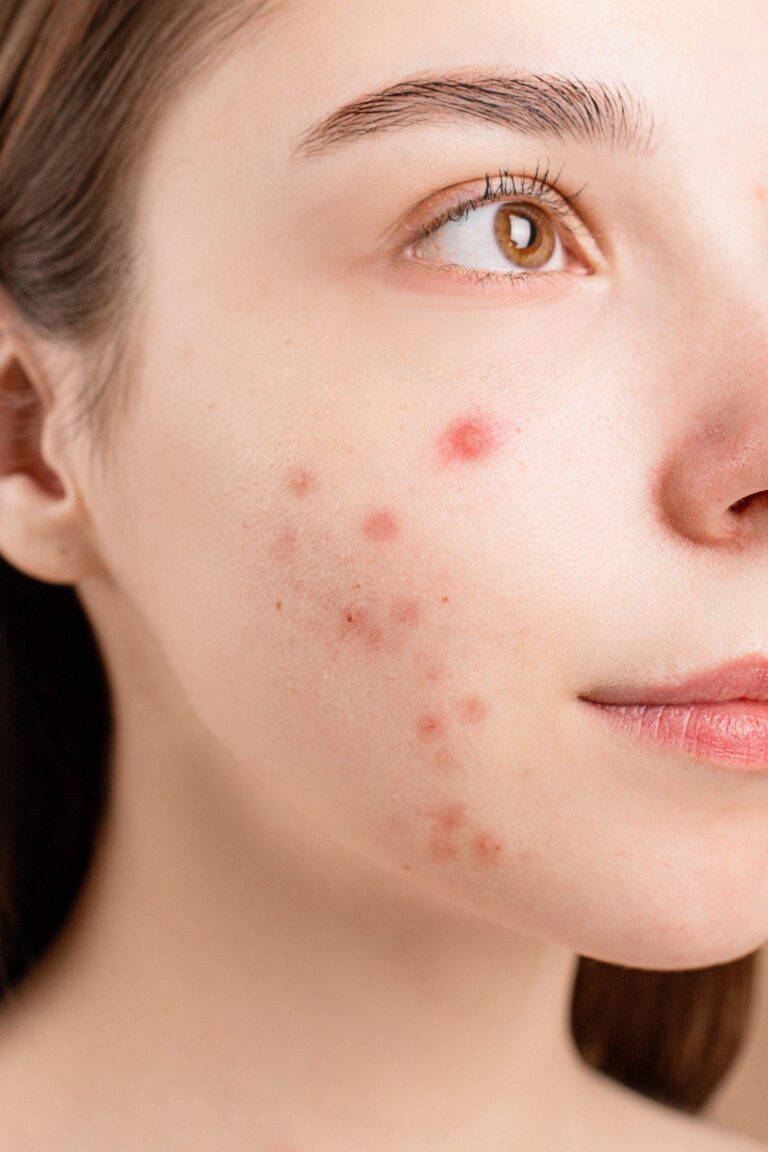 Aviclear: A Revolutionary Treatment for Acne