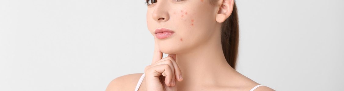Young,Woman,With,Acne,Problem,On,Light,Background